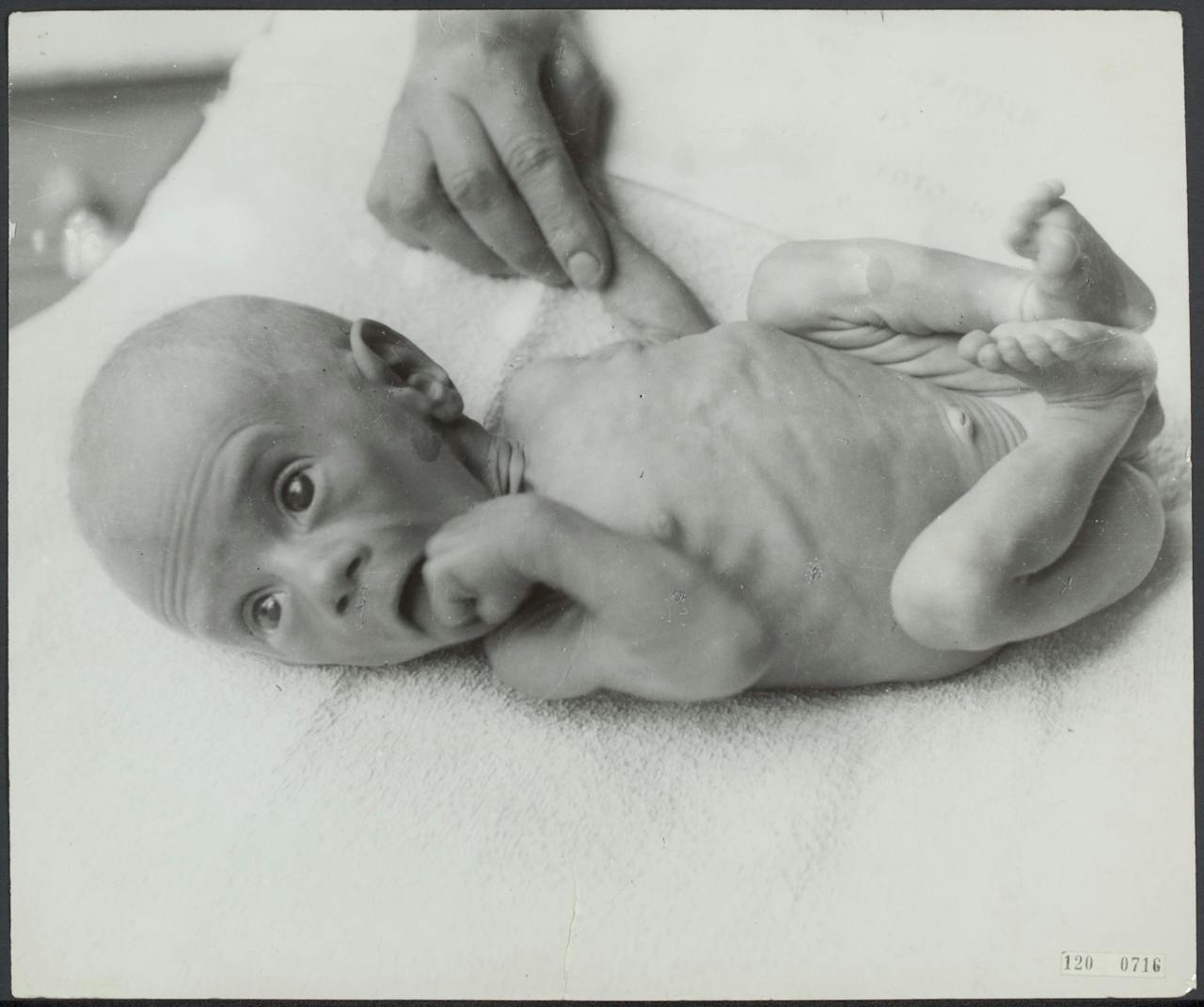 Ondervoede baby tijdens de Hongerwinter 1944-1945. En ondervoede baby tijdens de Hongerwinter van 1944-1945.
